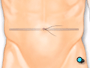 Sutures resembling a purse string are placed in the skin around the navel.